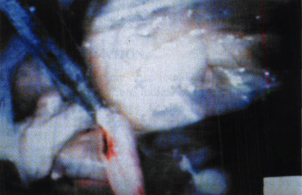 十一、腎臟的腹腔鏡手術(shù)